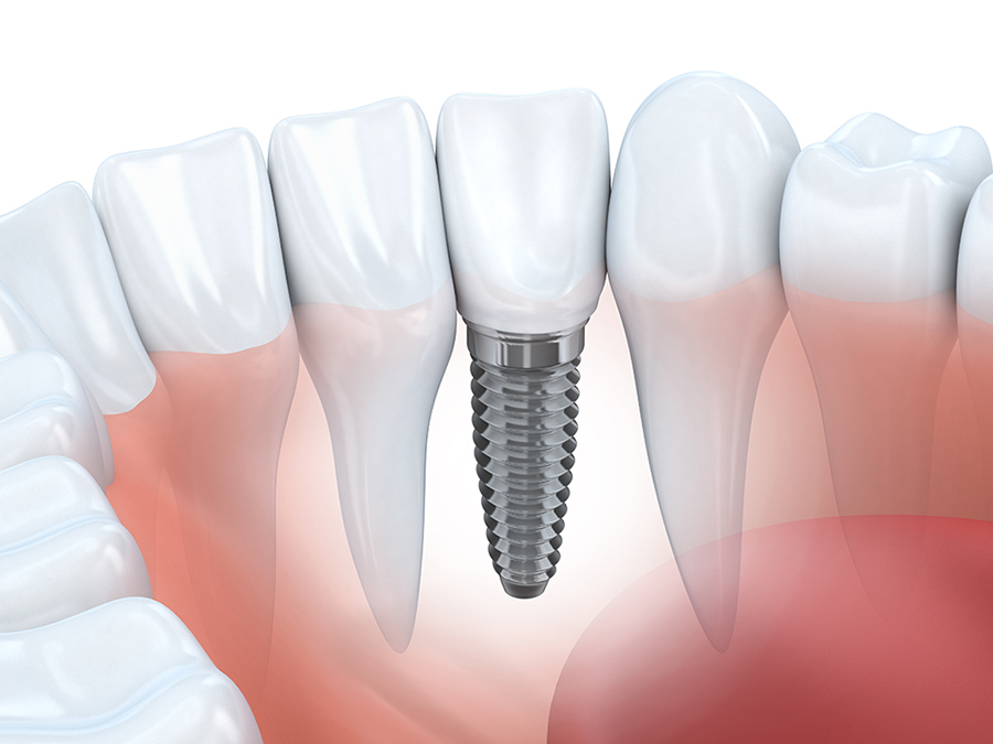 Implant dentaire Aix en Provence