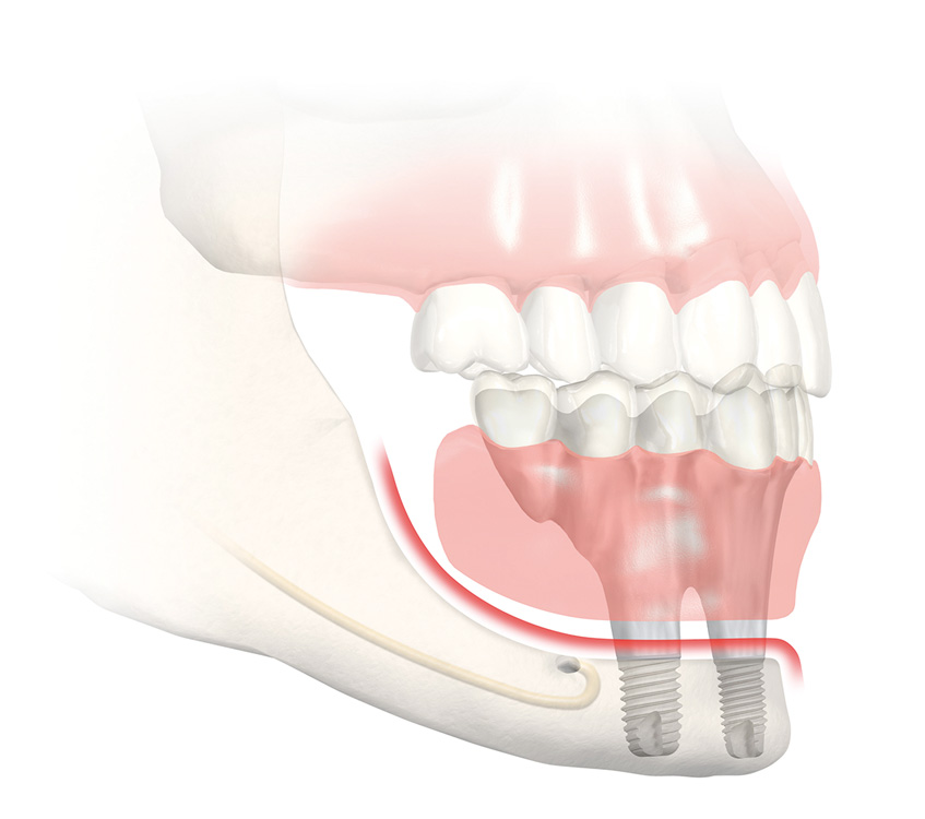 Implant dentaire Aix en Provence